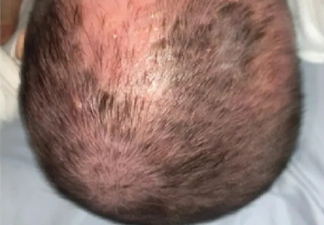 Bé 8 tháng tuổi bị bong tróc da đầu vì tắm lá chữa viêm da cơ địa 1