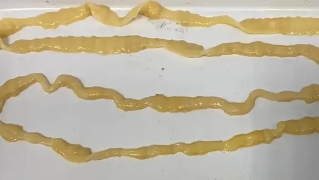 Sán dây dài 6 mét trong người cô gái thích ăn bò tái 1