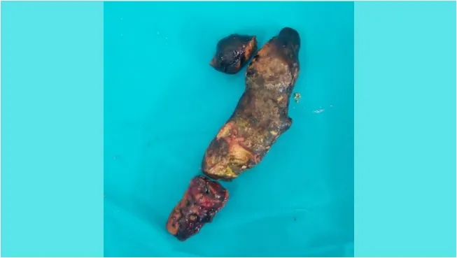 Cứu thành công bệnh nhân mắc sỏi đường mật 'hình cây' 1