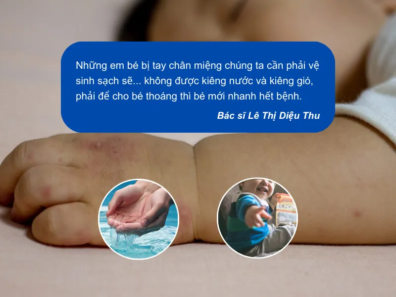 Bị tay chân miệng kiêng gì? 3 sai lầm thường gặp khiến bệnh lâu khỏi 1