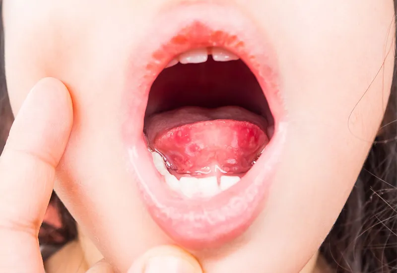 Trẻ bị biến chứng lở loét vì cha mẹ tự điều trị Tay Chân Miệng 1
