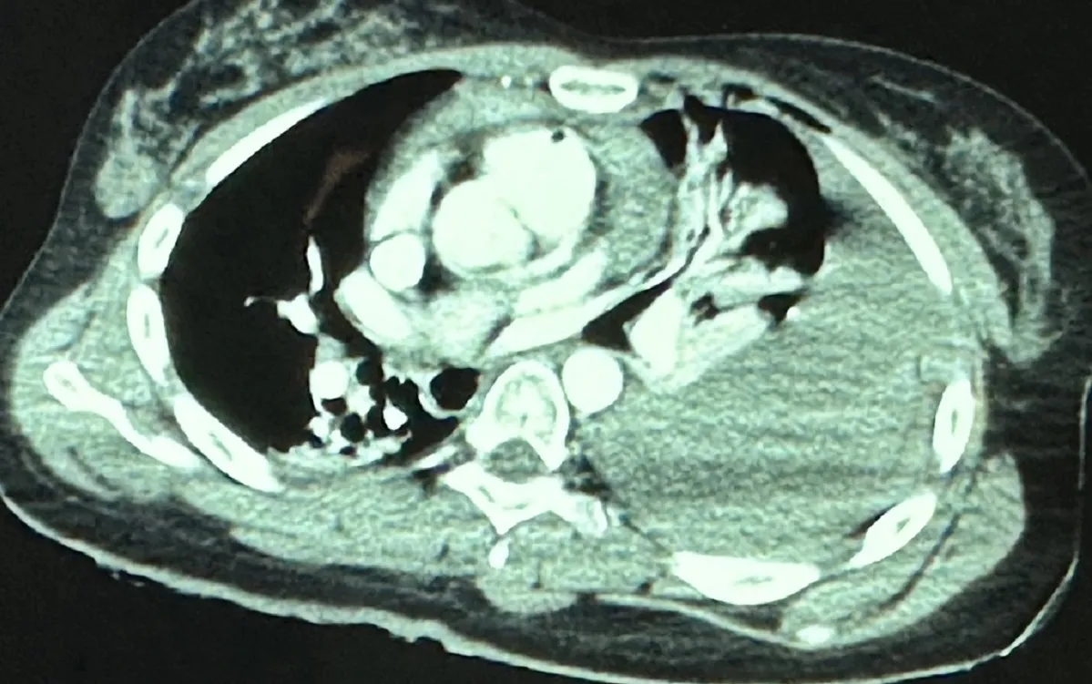 Bệnh nhân được chụp CT lồng ngực trước mổ, phát hiện nhiều vết thương phức tạp (Ảnh: BS).