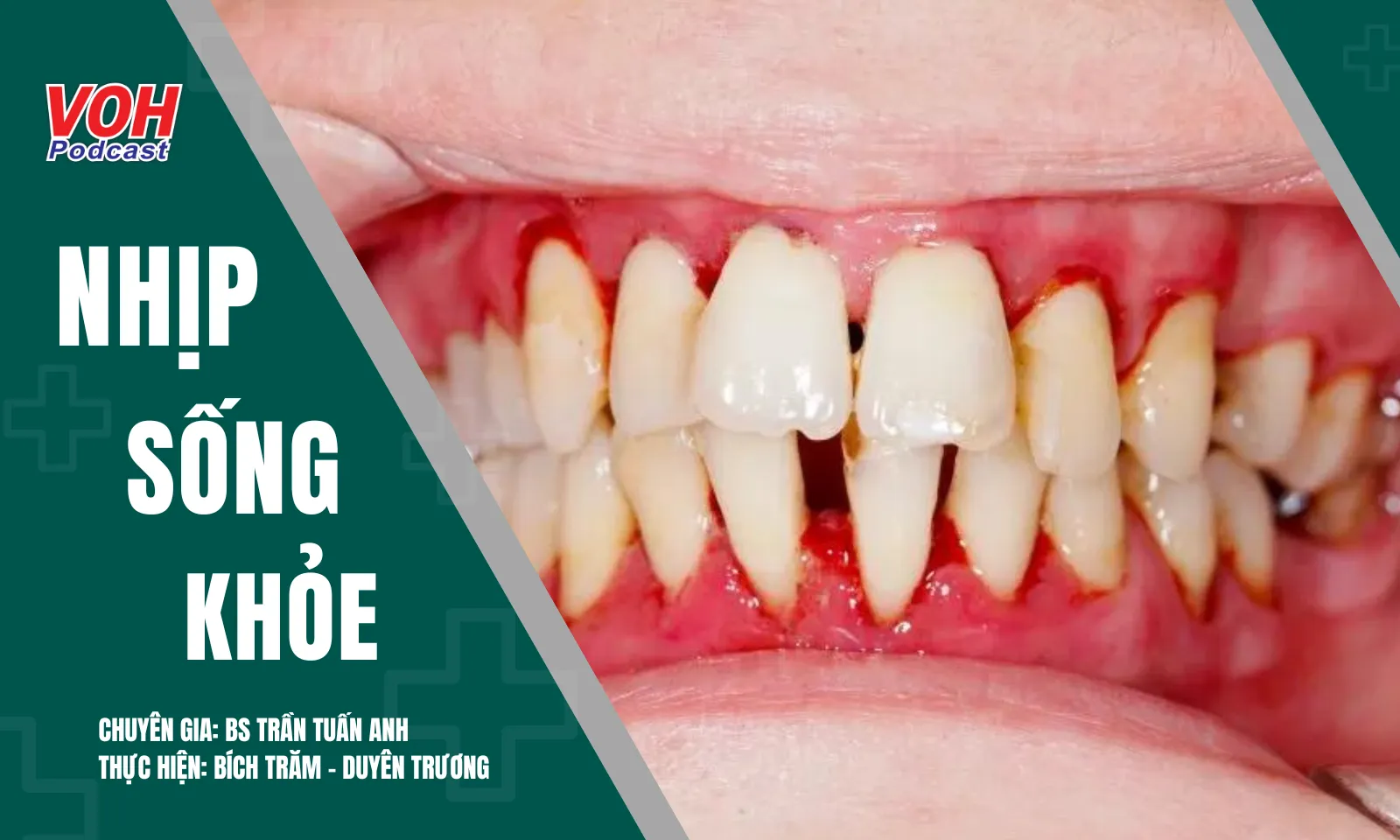 Bệnh nha chu: Mối nguy hiểm lặng lẽ đe dọa sức khỏe răng và nướu