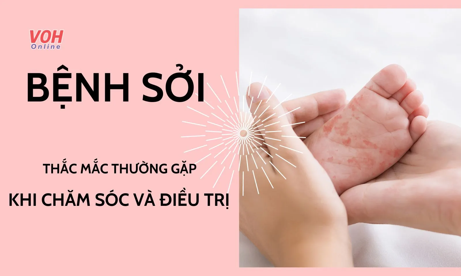 4 thắc mắc thường gặp về bệnh sởi khiến nhiều người hoang mang