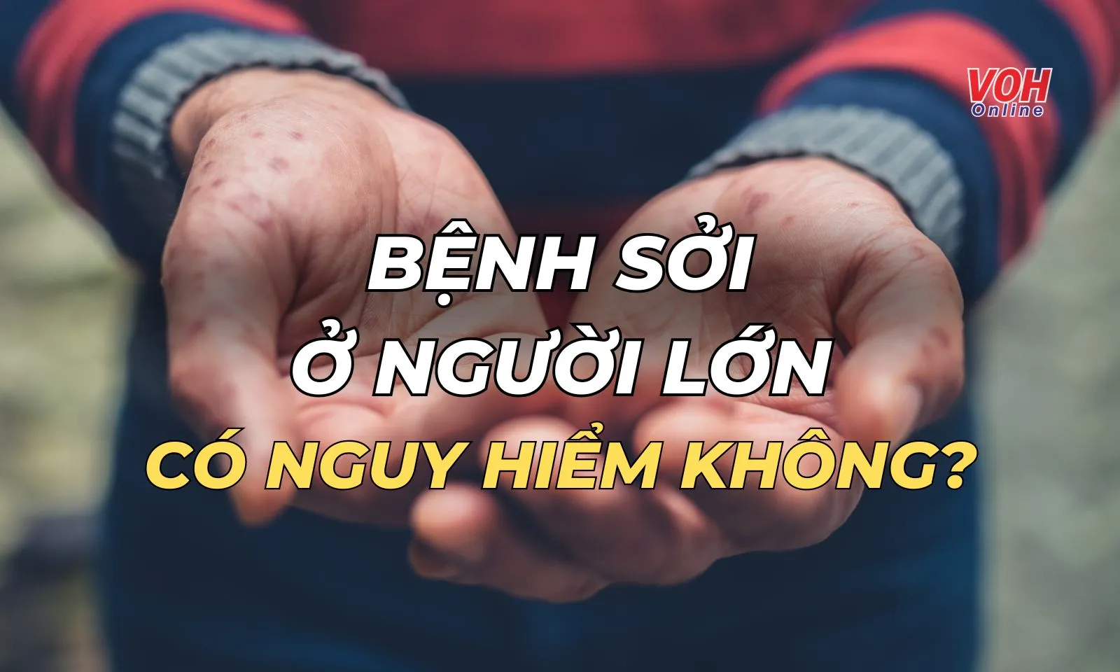 Triệu chứng bệnh sởi ở người lớn là gì và có nguy hiểm không?