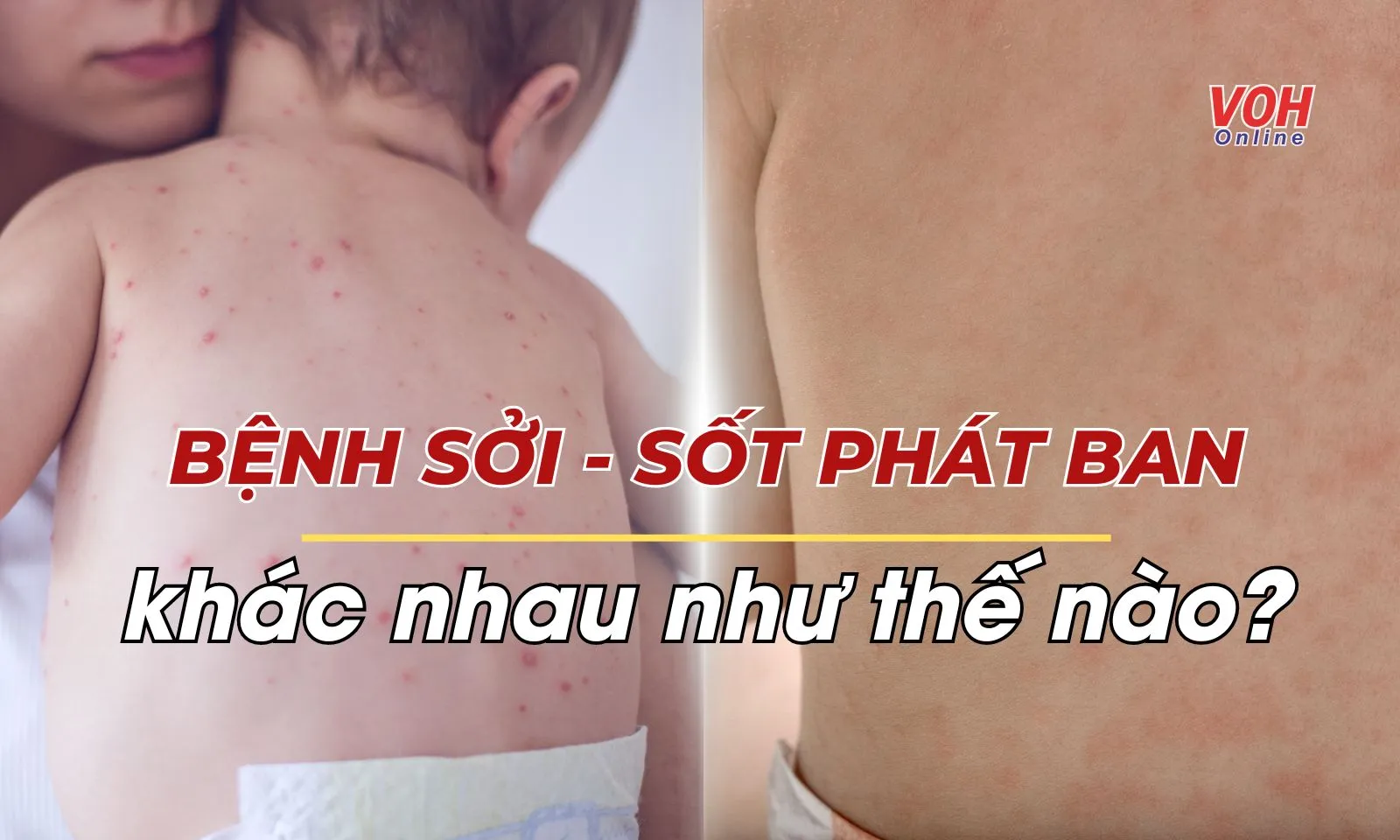 Bệnh sởi và sốt phát ban khác nhau như thế nào?