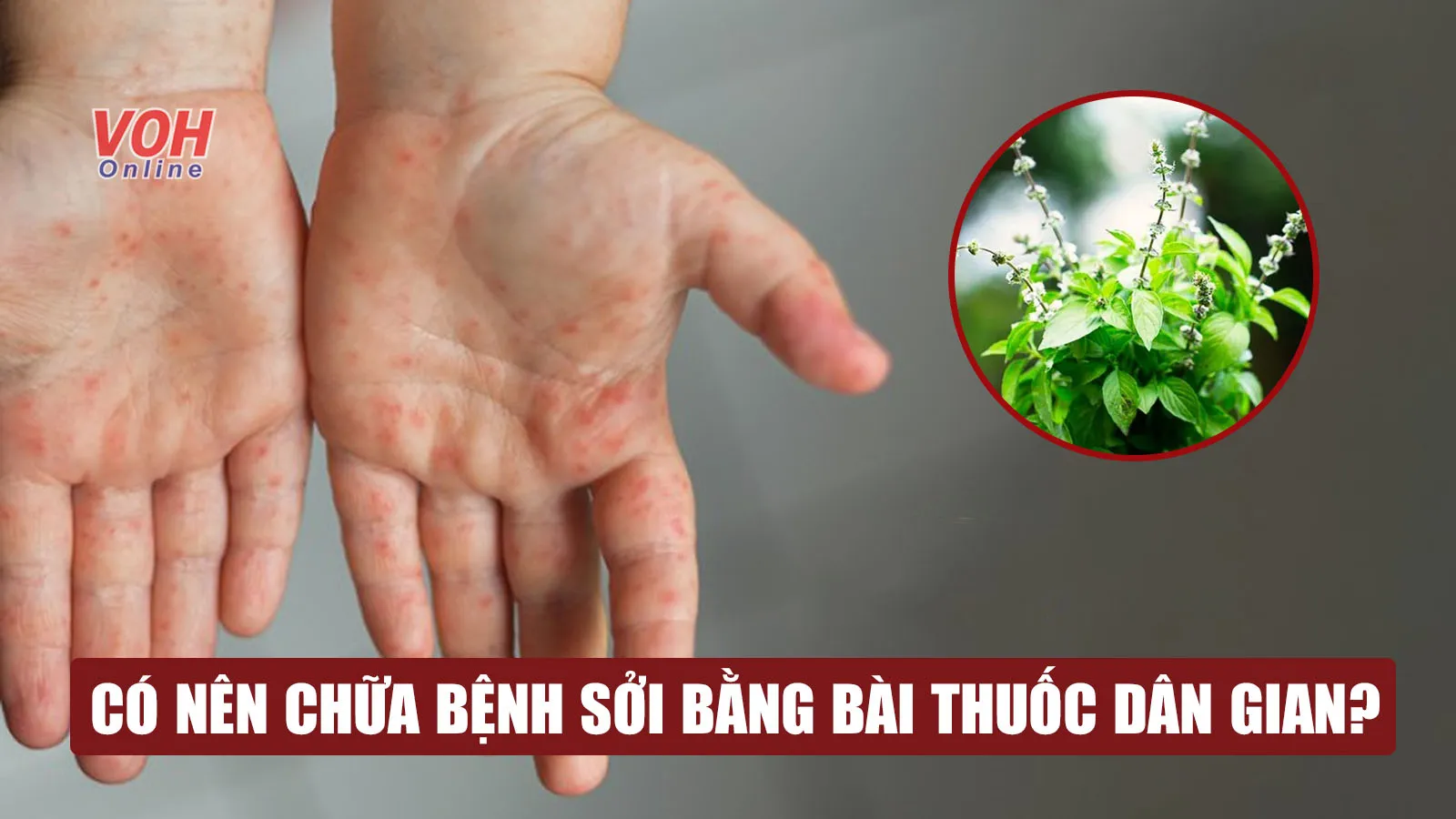 Chữa bệnh sởi bằng bài thuốc dân gian có an toàn, hiệu quả?