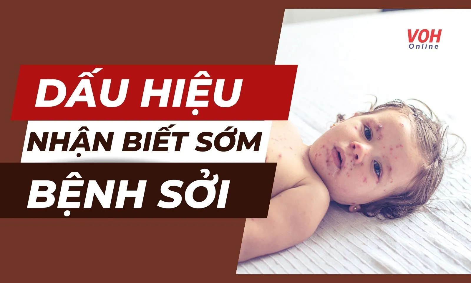 Cách nhận biết sớm các dấu hiệu bệnh sởi ở trẻ em