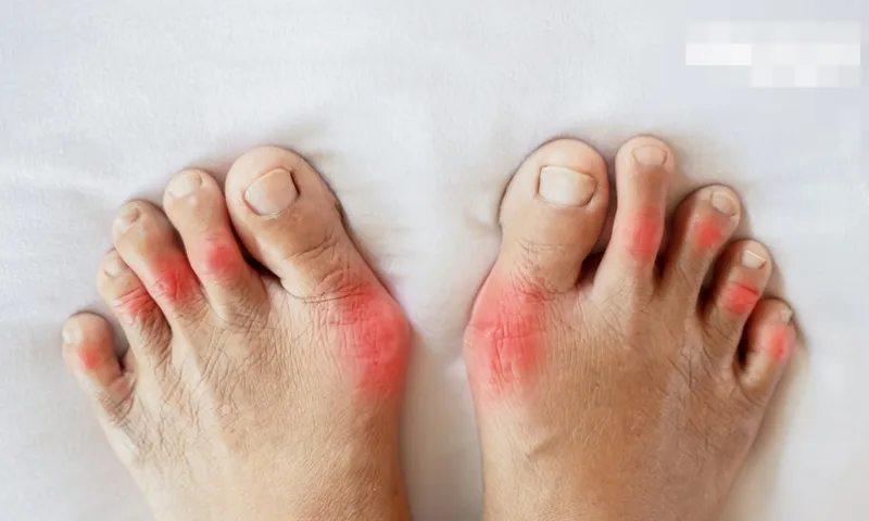 Ổi ruột đỏ tốt cho người bệnh gout