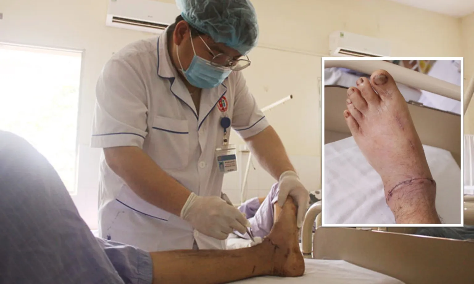 Nối thành công bàn chân gần đứt rời cho bệnh nhân