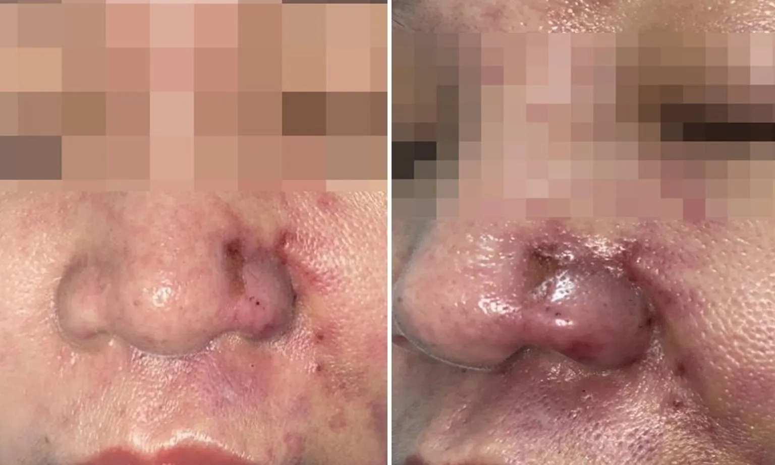 Tắc mạch sau khi tiêm filler tại cơ sở làm đẹp không uy tín