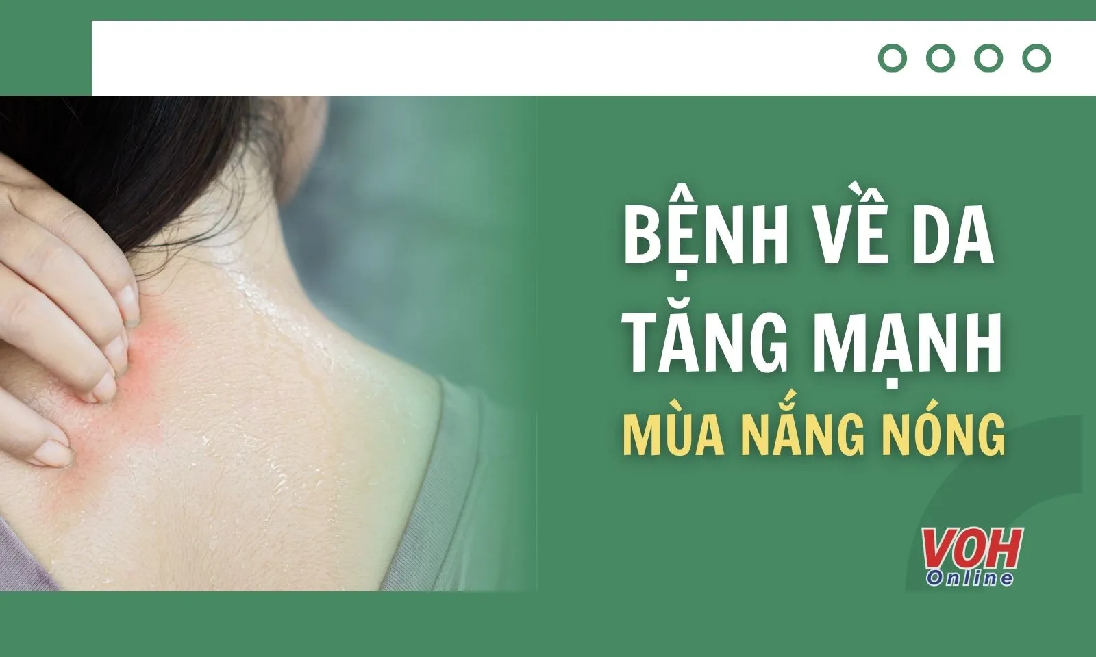 Vì sao số người mắc bệnh về da tăng mạnh trong mùa nắng nóng?