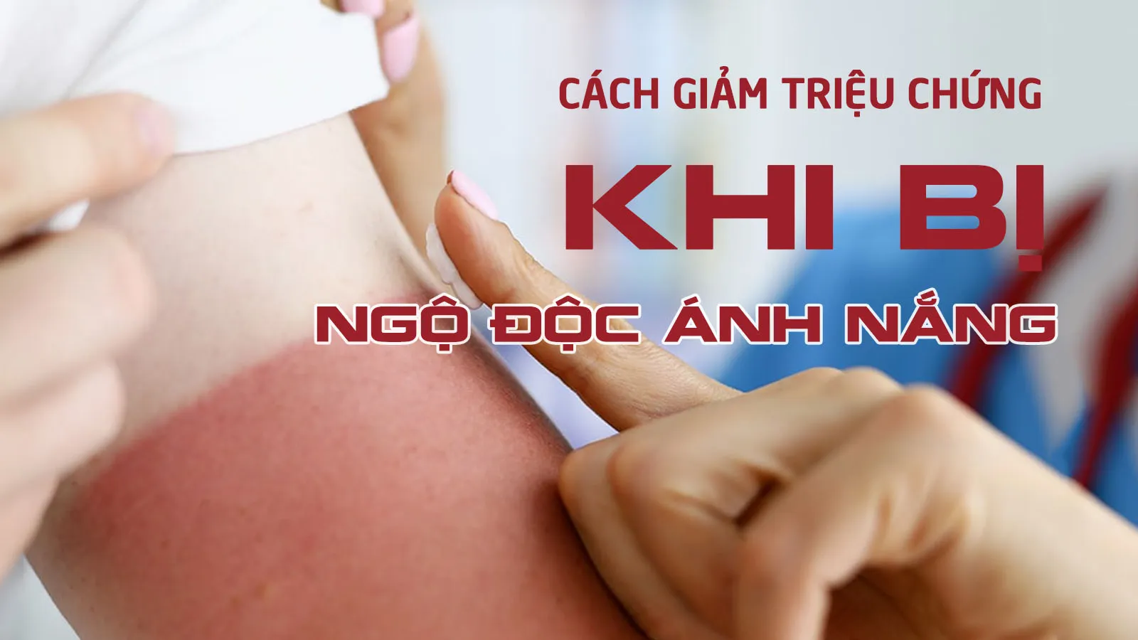 Bị bỏng nắng (cháy nắng) cần làm gì để giảm các triệu chứng?