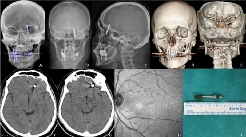 Nha sĩ vô tình đẩy ốc implant vào não bệnh nhân 