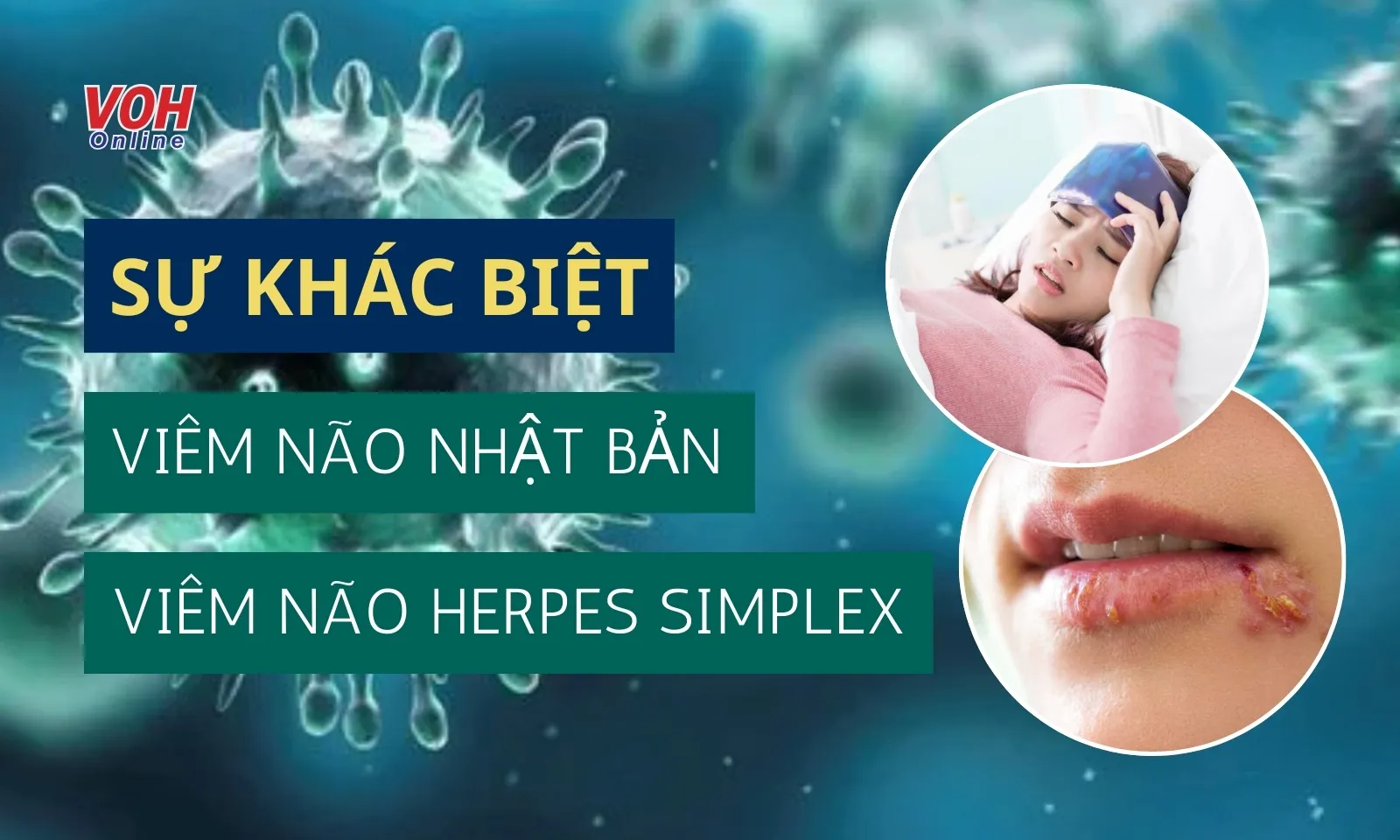 Sự khác biệt giữa viêm não Nhật Bản và viêm não Herpes Simplex