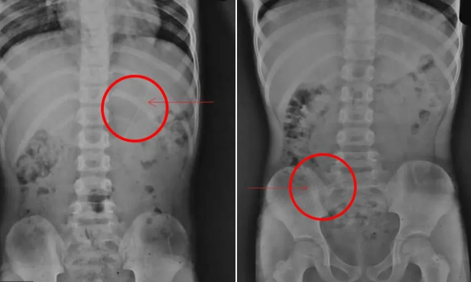 Kỳ lạ: Cậu bé 7 tuổi nuốt cây bút chì dài 10cm và tự đào thải mà không gặp vấn đề gì