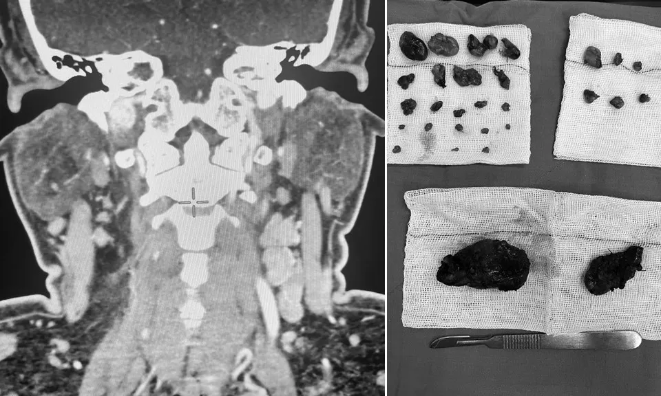 Chủ quan với kết quả sinh thiết lành tính, sau 3 năm phát hiện khối bướu giáp ác tính di căn
