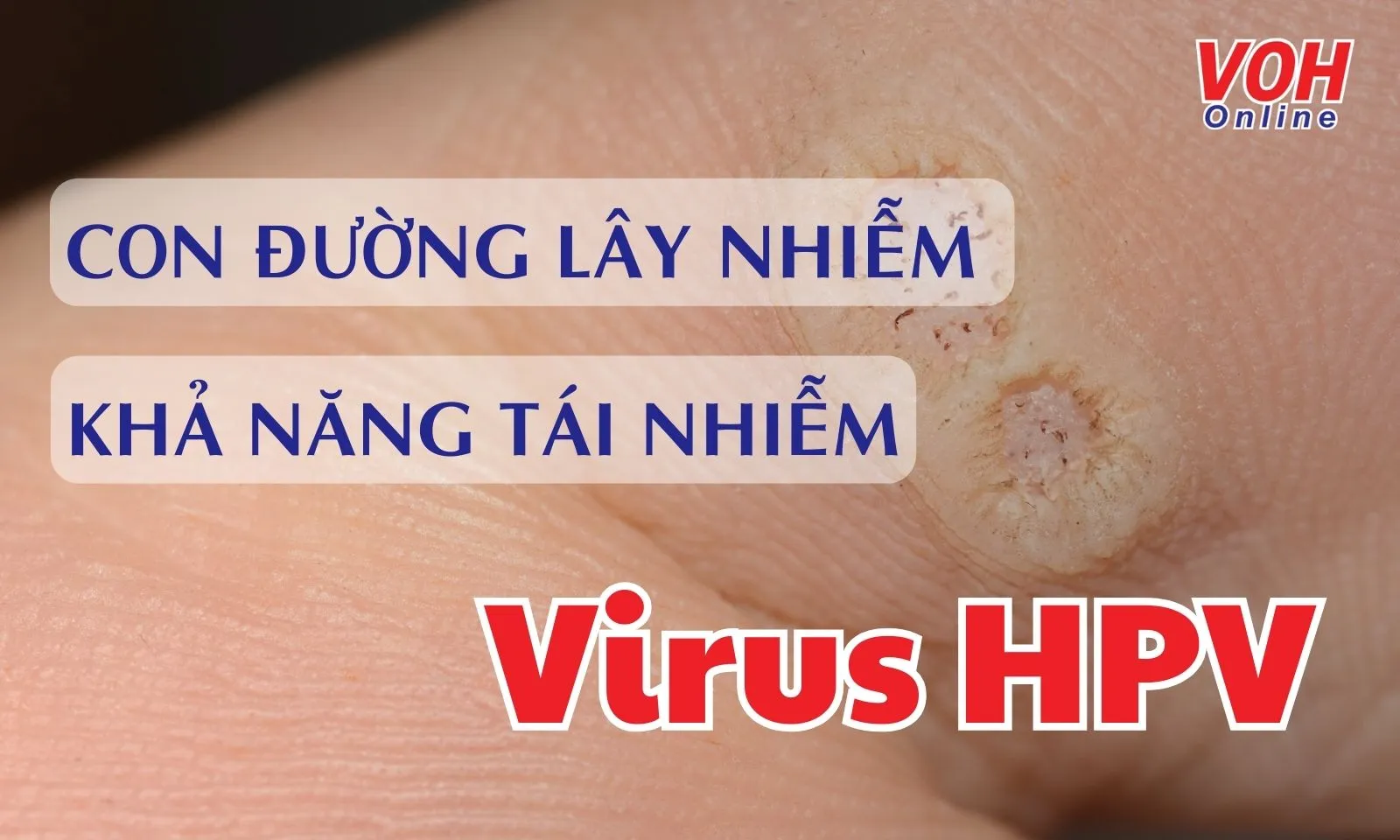 Virus HPV lây nhiễm như thế nào?