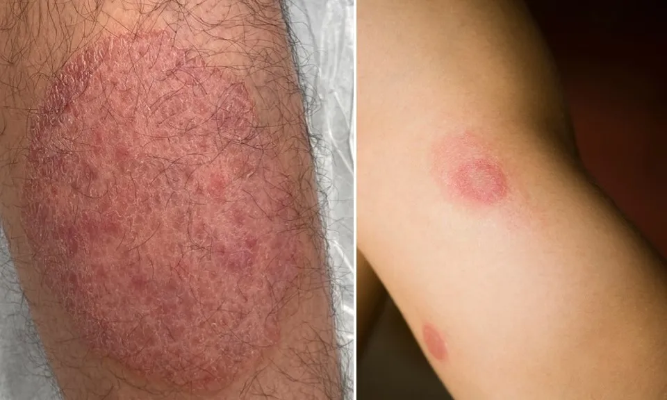 Mỹ phát hiện trường hợp đầu tiên nhiễm hắc lào lây truyền qua đường tình dục