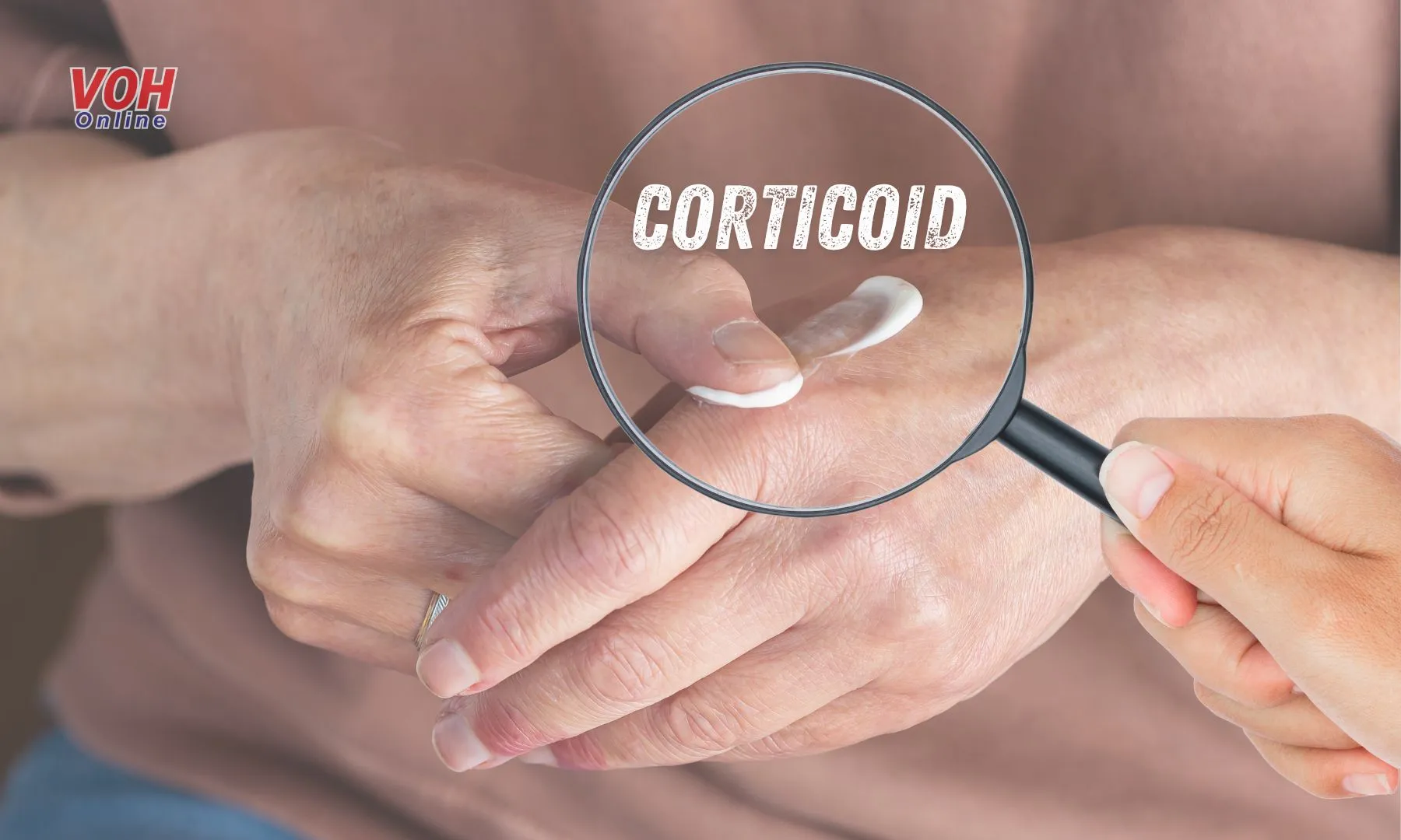 Có nên chữa bệnh nấm da bằng thuốc bôi Corticoid?