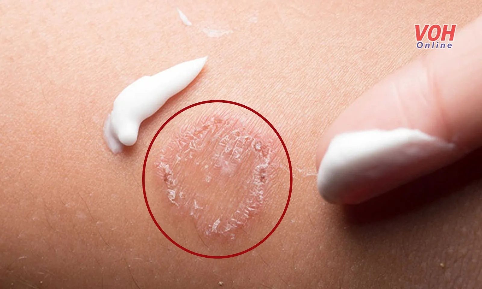 Có thể điều trị nấm da tại nhà hay không? 