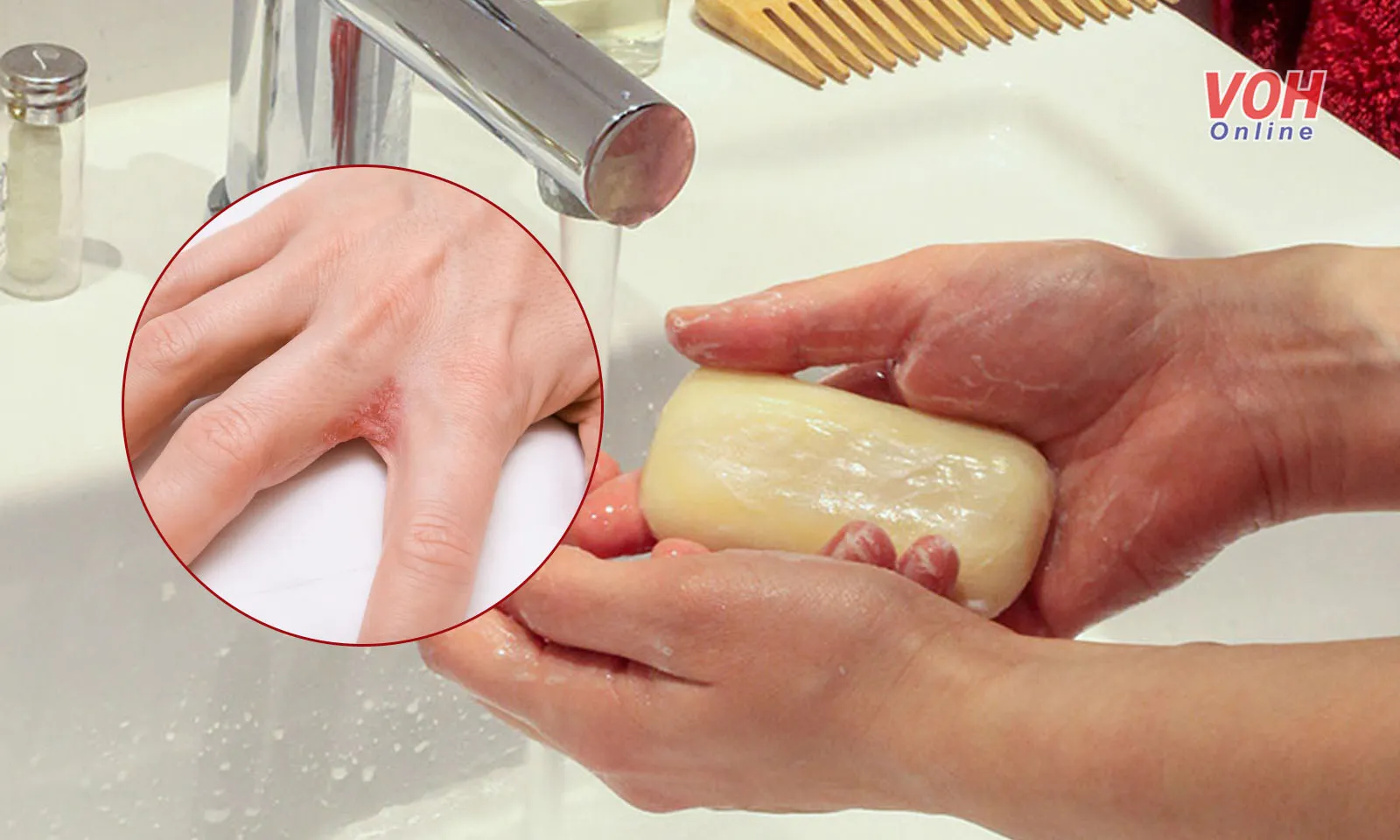 Người bệnh nấm da có nên sử dụng xà phòng để tắm hay không?