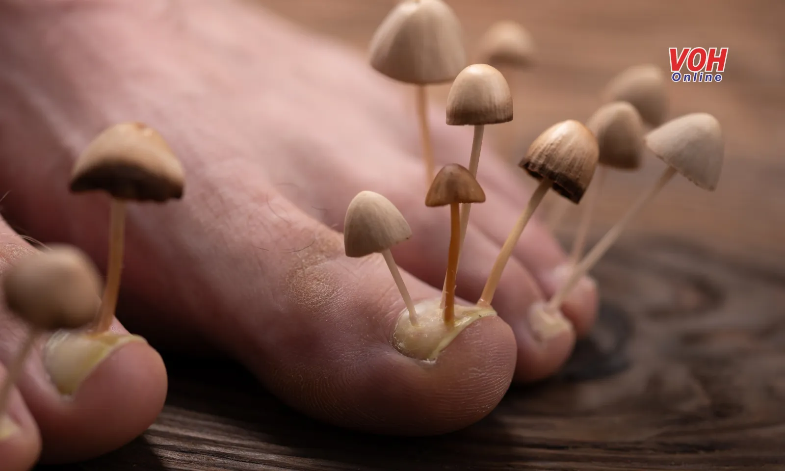 Phân biệt nấm da và viêm da cơ địa