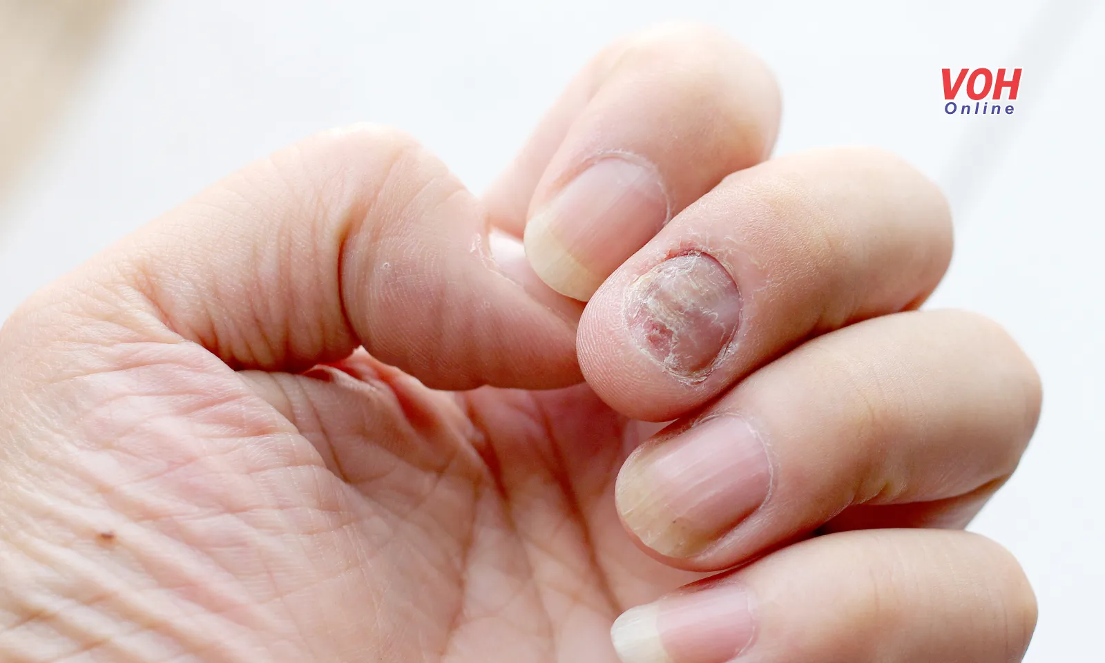 Nguyên nhân gây ra bệnh nấm da ở người