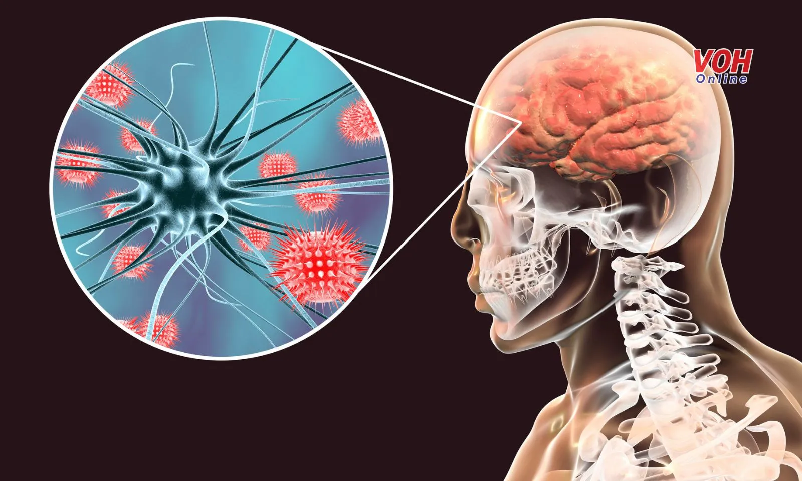 Viêm não mô cầu là bệnh gì? Nguyên nhân gây bệnh viêm não mô cầu 