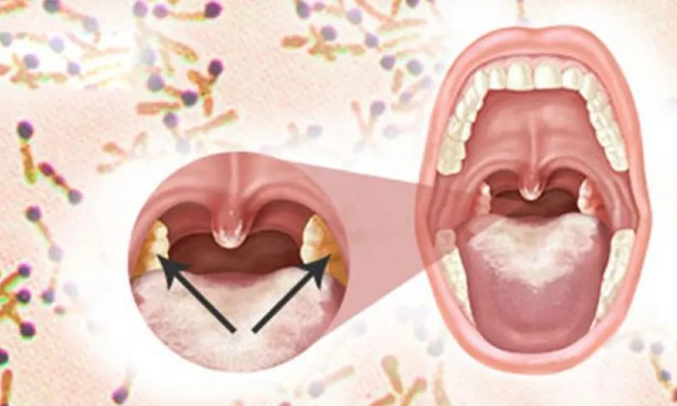Điểm tin chiều 11/7: Bệnh nhân nghi ngờ mắc bạch hầu ở Hà Tĩnh có kết quả xét nghiệm âm tính
