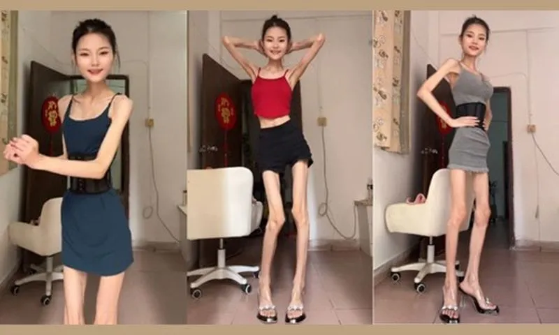 Cô gái Trung Quốc cao 1m60 gây tranh cãi với vóc dáng siêu gầy chỉ 25kg