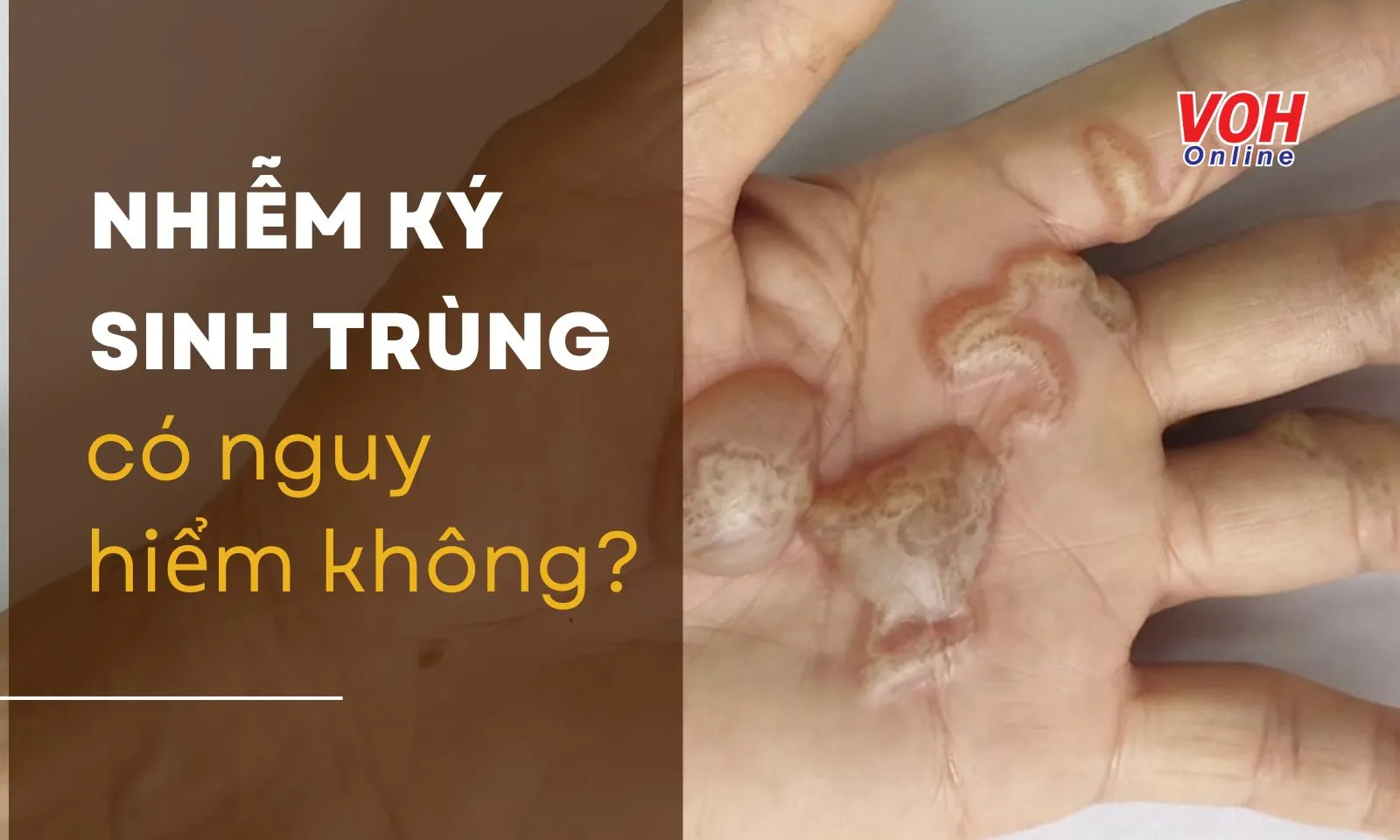 Bệnh do ký sinh trùng gây ra có nguy hiểm không?