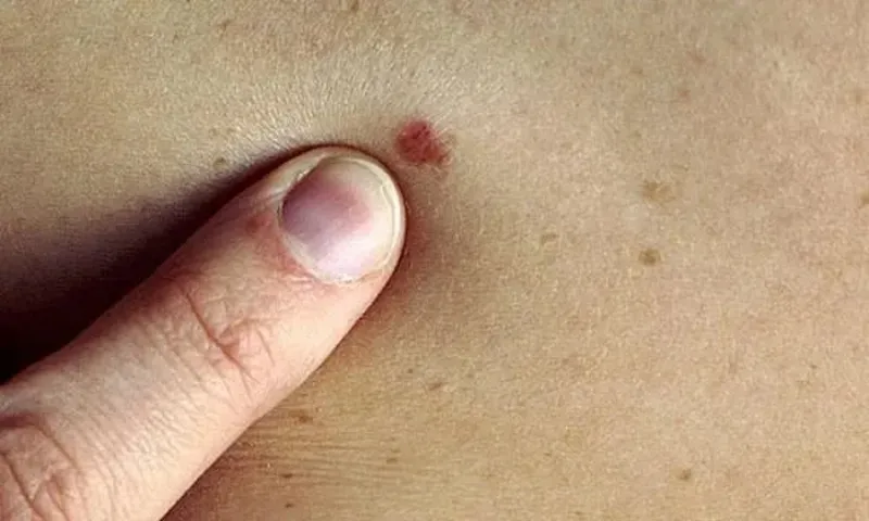 Ung thư da có chữa khỏi được không?