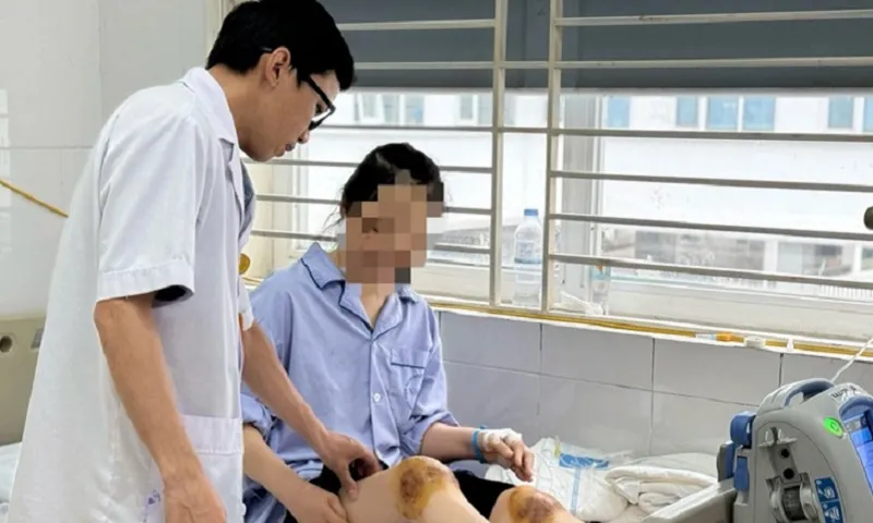 Một phụ nữ bị hoại tử cẳng chân vì dùng ong châm trị đau khớp gối