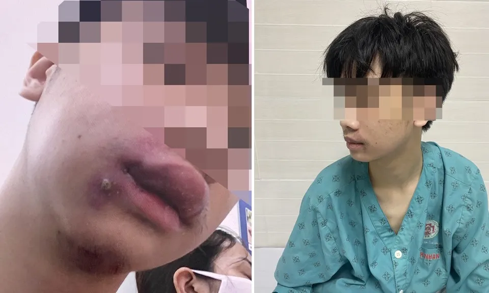 Nam thanh niên nhiễm khuẩn huyết vì nặn mụn mủ trên mặt