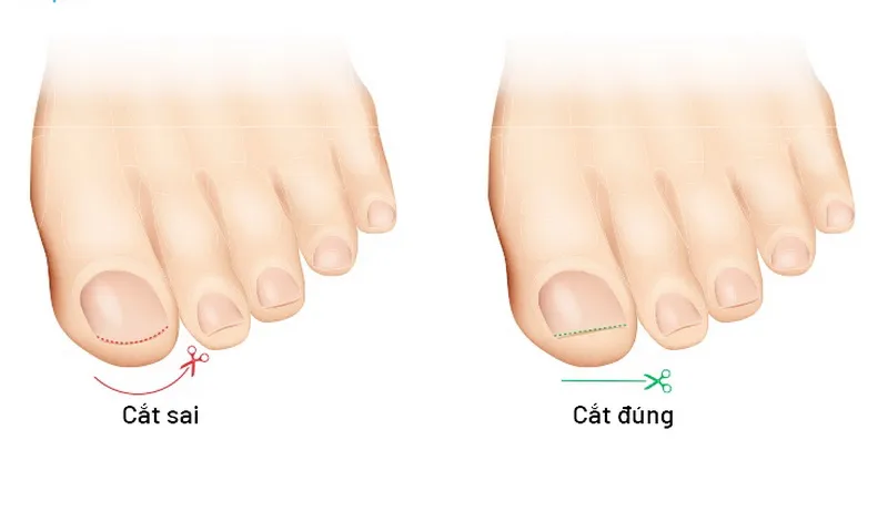 Móng quặp là gì? Dấu hiệu, nguyên nhân và cách xử lý móng quặp, mọc ngược
