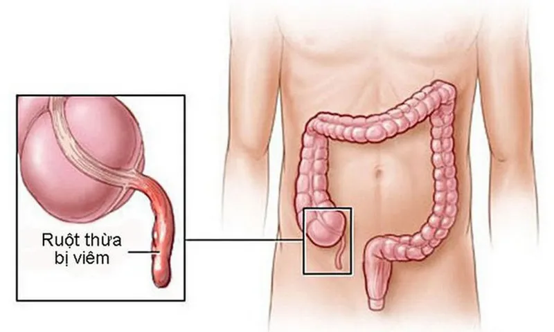 Viêm ruột thừa: phát hiện sớm phòng biến chứng