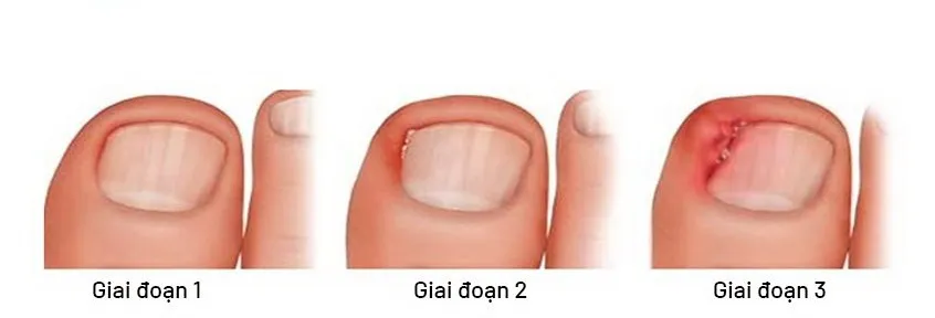 trieu-chung-cua-mong-quap-e1651052331960