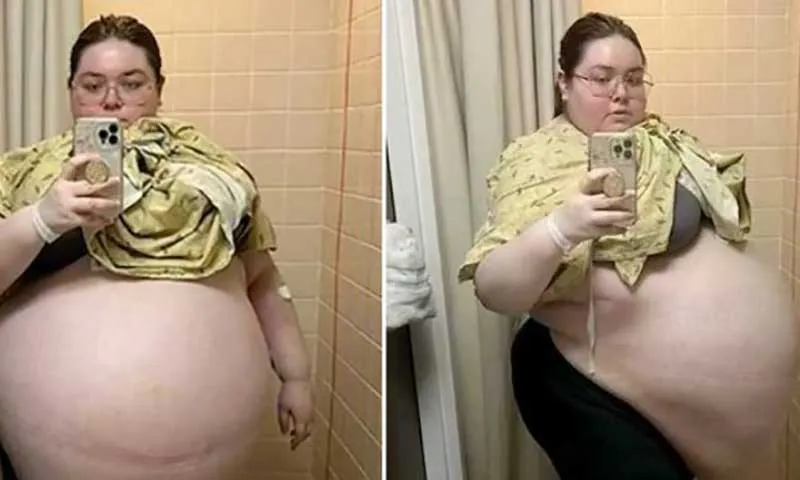 Cô gái bụng to như mang đa thai, khi gặp bác sĩ mới biết sự thật