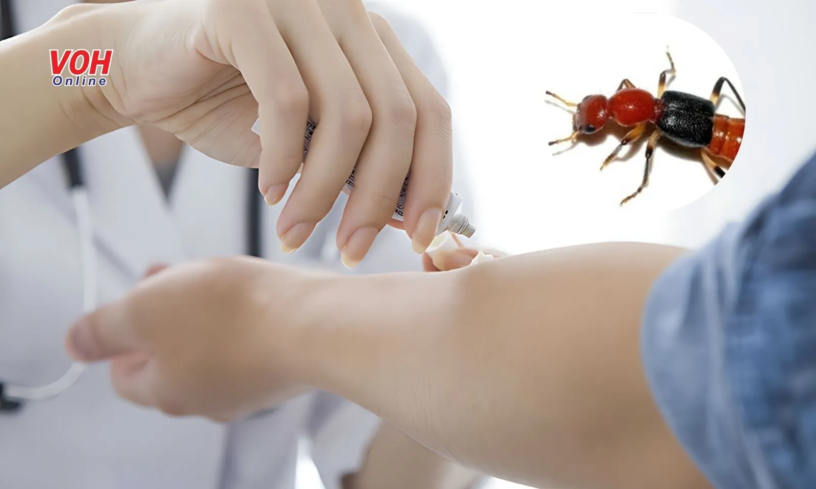 Những lưu ý cần biết khi dính dịch kiến ba khoang