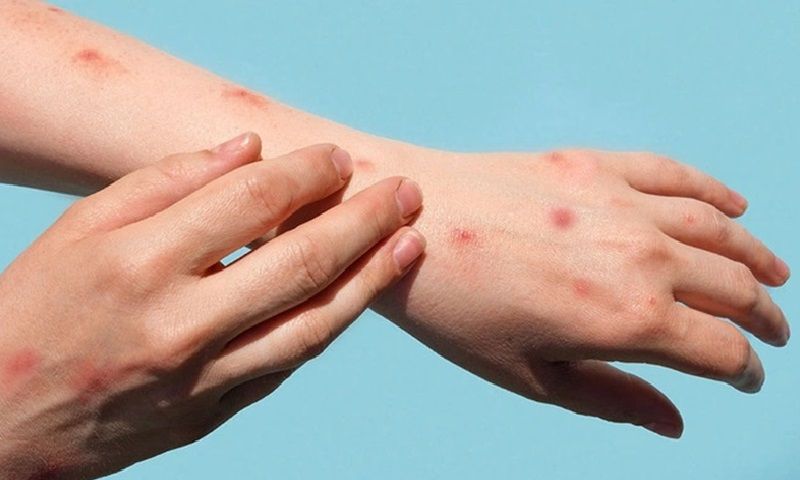 Tổ chức Y tế thế giới họp khẩn bàn về bệnh đậu mùa khỉ