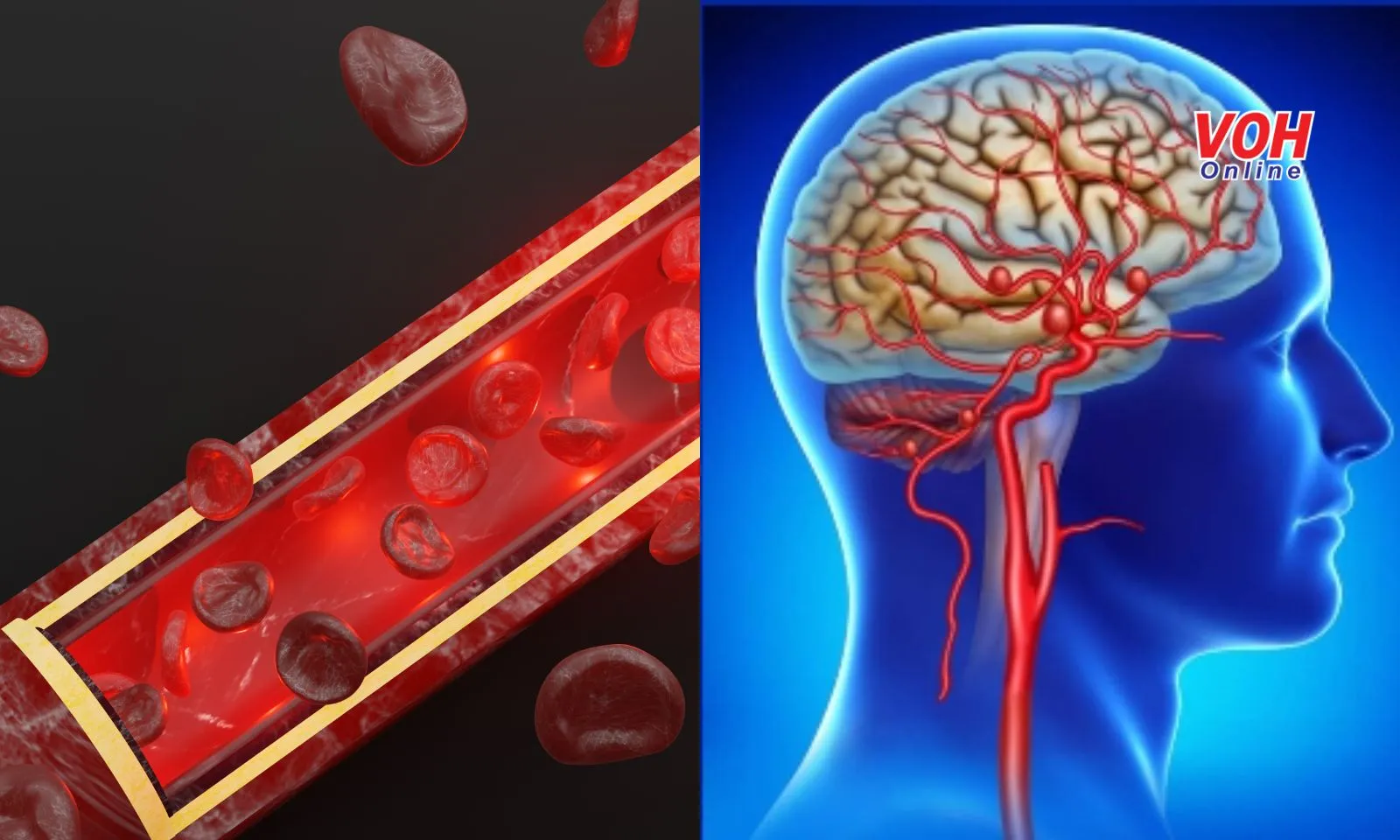Phình mạch máu não là gì? Nguyên nhân nào gây ra bệnh?