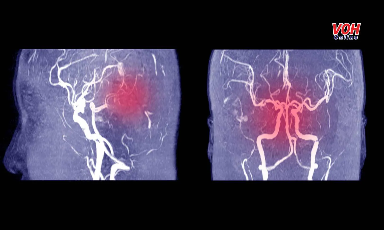 Phát hiện bệnh phình mạch máu não bằng cách nào?