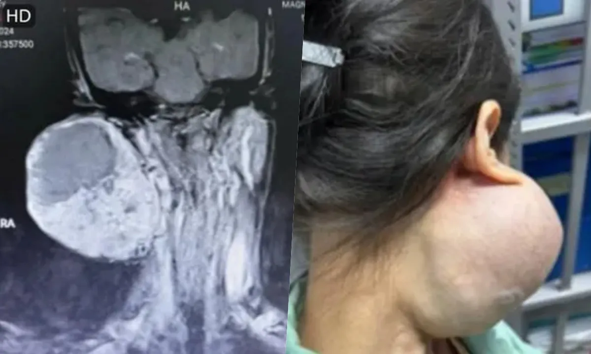 Suýt chết vì khối u khổng lồ trên mặt lâu năm 