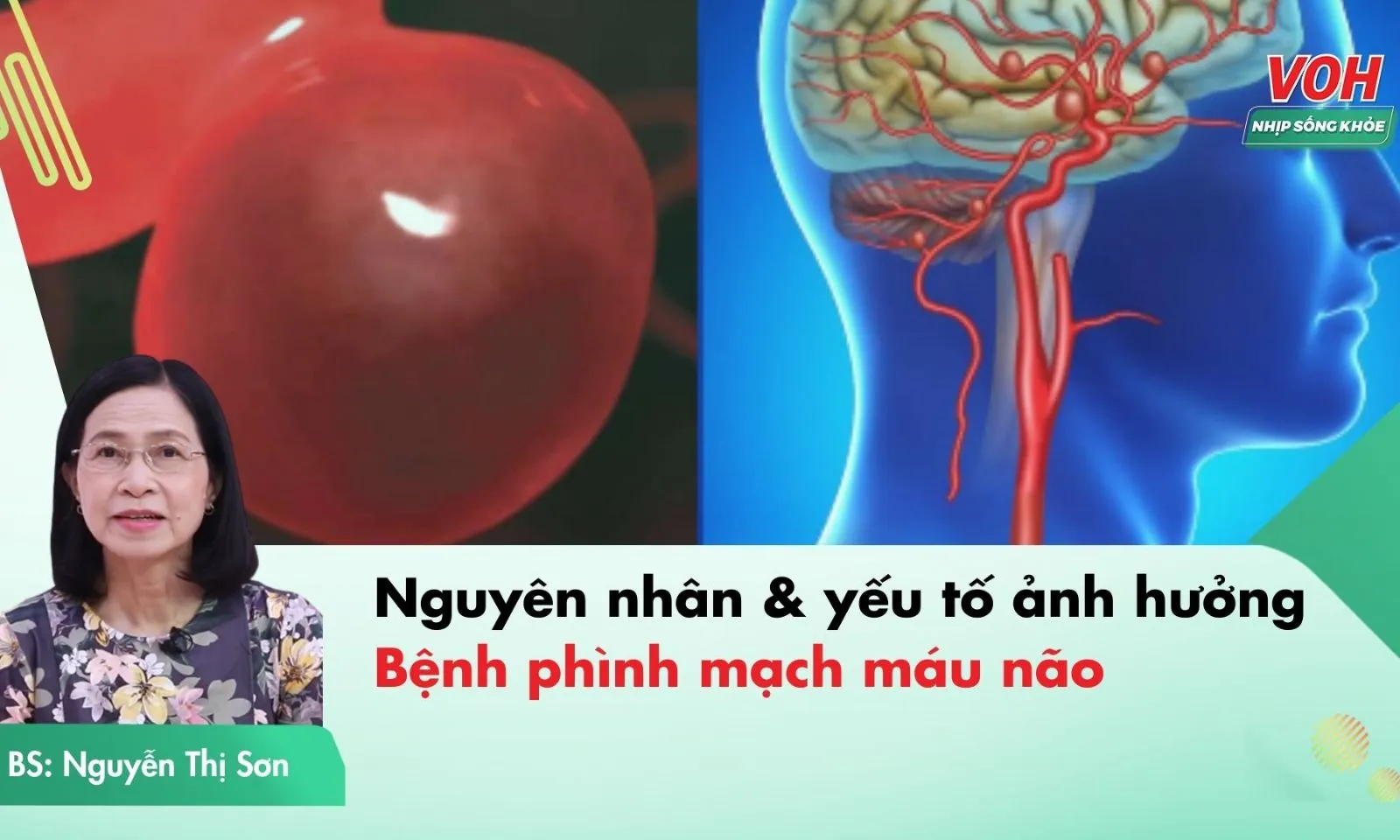 Bệnh phình mạch máu não là gì? Nguyên nhân gây bệnh?