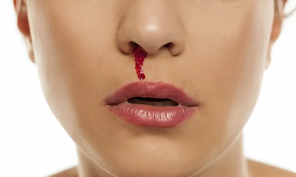 Chảy máu cam - dấu hiệu cảnh báo bệnh tim tiềm ẩn