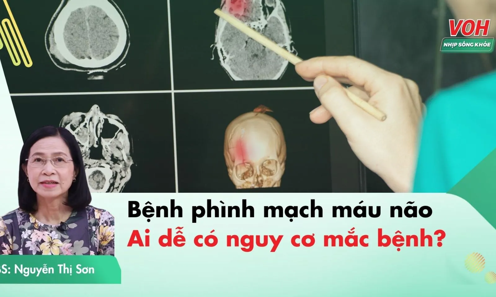 Ai có nguy cơ mắc bệnh phình mạch máu não?