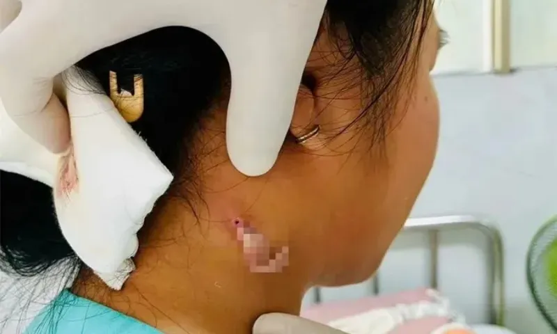 Đồng Nai ghi nhận ca bệnh Whitmore đầu tiên