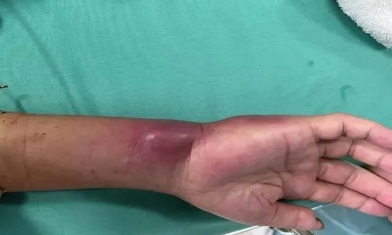  Phát hiện thêm hai ca nhiễm vi khuẩn ăn thịt người