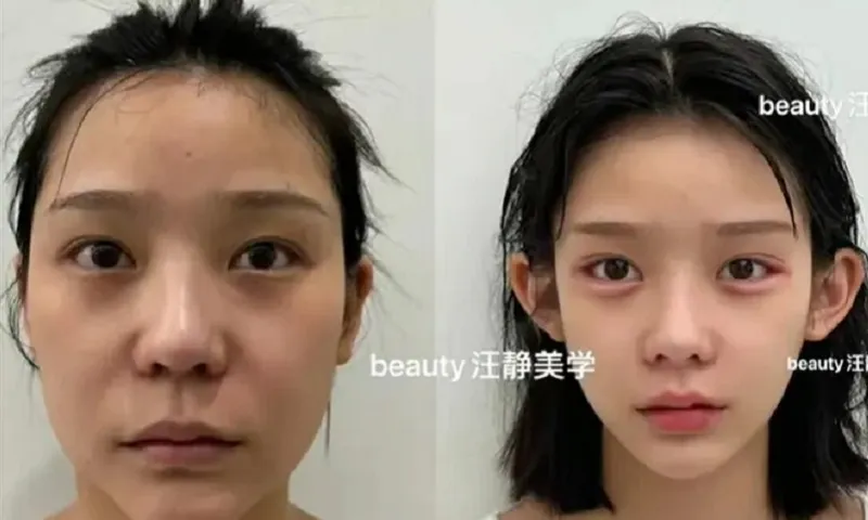 Xu hướng làm đẹp mới ở Trung Quốc: Khuôn mặt trẻ thơ từ phẫu thuật thẩm mỹ
